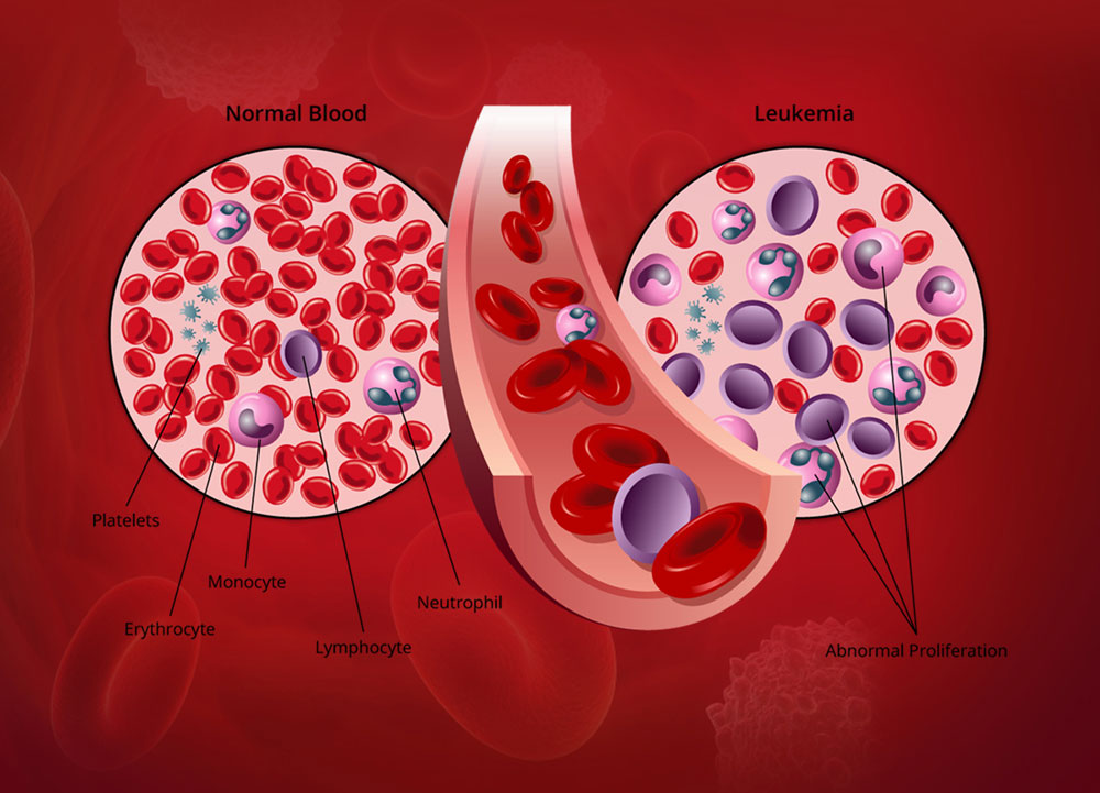Child Leukemia Treatment