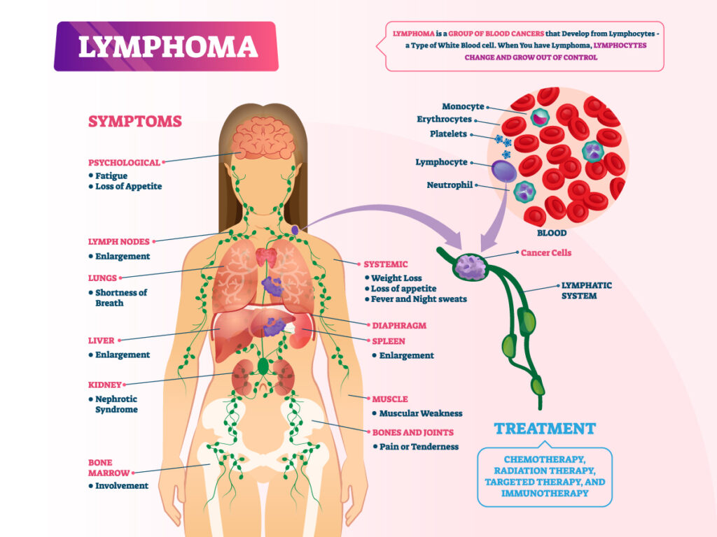 Pediatric Lymphoma Treatment